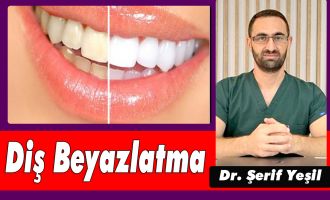 Diş Beyazlatma