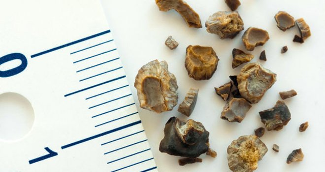 Böbrek taşı nedir? Nasıl tedavi edilir?