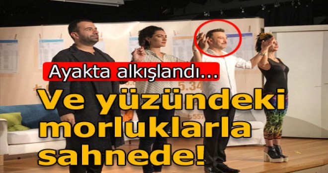 Hakan Yılmaz yüzündeki morluklarla sahnede