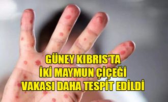 Güney Kıbrıs’ta iki maymun çiçeği vakası daha tespit edildi