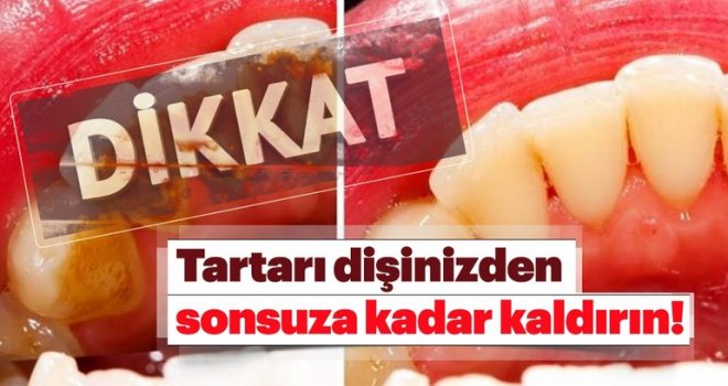 Tartarı dişinizden sonsuza kadar kaldırın