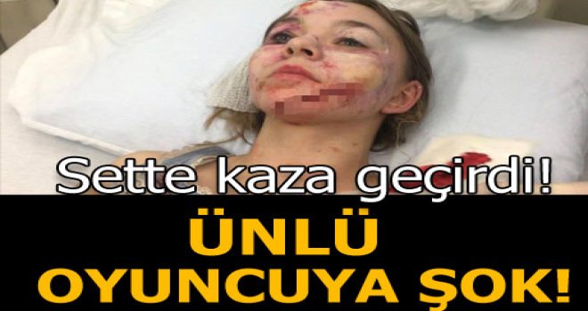 Taylor Hickson'un yüzünde set kazası yüzünden yaralar oluştu